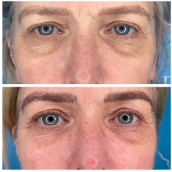 Don&rsquo;t like the thought of Botox or dermal filler? Here&rsquo;s a natural alternative: Platelet Rich Fibrin (PRF) treatment.&nbsp;