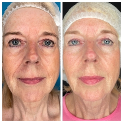 Full face rejuvenations