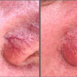 How to treat small vessels on the face.