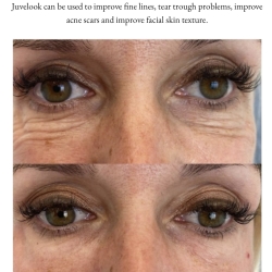 The long lasting Juvelook and Lenisna (PDLLA and HA hybrid) treatments